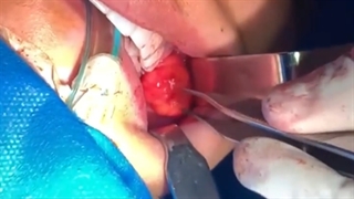 تغییر چهره با بوکال فت | دکتر شاهرخ خوش سیرت