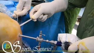 بازسازی رباط صلیبی قدامی زانو در  آسیبهای ورزشی