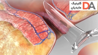 درمان بواسیر (هموروئید) با لیزر - درمان تهران پریودنتیکس
