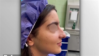 قبل و بعد جراحی زیبایی بینی بزرگ با قوز زیاد | دکتر خوروش