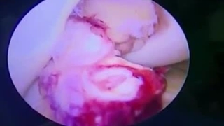 بازسازی رباط صلیبی قدامی