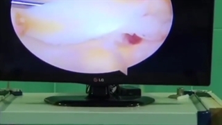 درمان پارگی منیسک به روش آرتروسکوپی