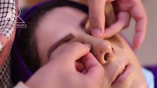 چسب زدن بینی بعد از جراحی