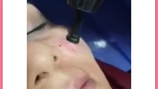 جوانسازی پوست صورت با لیزر آر اف فرکشنال (RF Fractional) برداشتن خال گوشتی