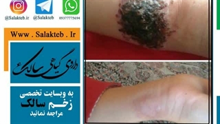 زخم قدیمی سالک برگشت دارد و عوت کننده است