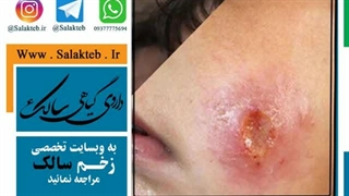 درمان گیاهی سالک با طب سنتی و طب اسلامی داروی قطعی