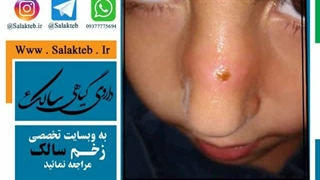 زخم سالک چیست و درمان لیشمانیا و جای زخم دندان شیری