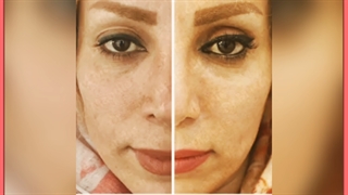 هزینه روش ها و مزایای لیفت چشم بدون جراحی برداشتن خال گوشتی