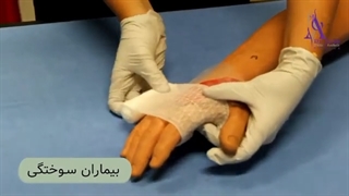 درمان قطعی بیماران سوختگی