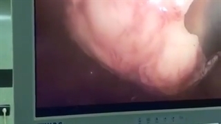 لاپاراسکوپی تورشن تخمدان راست