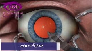 عمل آب مروارید چشم
