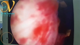 جراحی پروستات به روش بسته