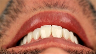 ایمپلنت و لمینت دندان (دکتر بهمن پوراقدم)02122220000