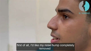 عمل بینی استخوانی مردانه