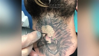 پاک کردن تتو بدن ( کلینیک زیبایی استار بیوتی )