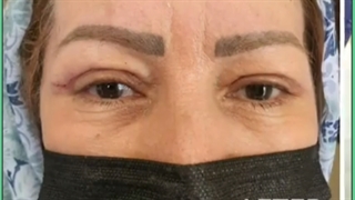 هزینه جراحی پلک چقدر است؟