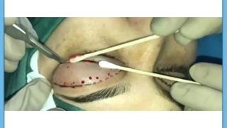 جراحی پلک بلفاروپلاستی _ هزینه و توصیه ها