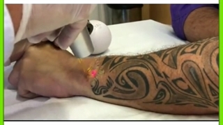 بهترین روش سریع پاک کردن تاتوی ابرو و بدن