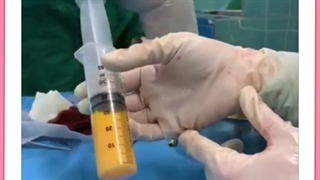 تزریق چربی در بهترین مرکز پوست و مو اردبیل