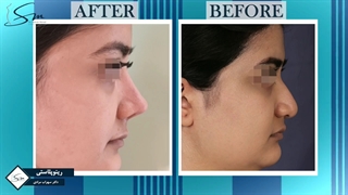 فیلم جراحی بینی طبیعی زنانه