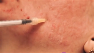 مزوتراپی با هدف جوانسازی، آبرسانی و روشن سازی و شفافیت پوست