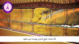 انیمیشن فول ابدومینوپلاستی