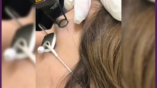 بهترین روش سریع پاک کردن تاتوی ابرو و بدن