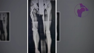 جراحی تعویض مفصل ران و درمان کوتاهی و کج جوش خوردگی | دکتر کاوه قرنی زاده