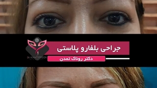 فیلم جراحی پلک ( بلفاروپلاستی )