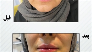 تاثیر برجستگی لب بر روی چهره لیپوساکشن