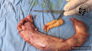 اسلیو معده همزمان با یرداشتن سنگ و کیسه صفرا