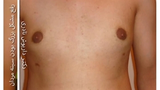 نمونه واقعی ژنیکوماستی