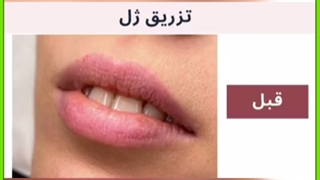 عوارض احتمالی تزریق ژل در نواحی مختلف صورت و بدن لیزر موهای زائد