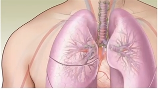 متاستاز یا گسترش سرطان چگونه صورت می گیرد؟