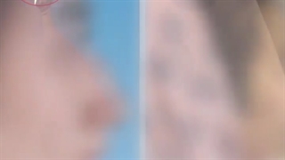 رینوپلاستی بینی استخوانی