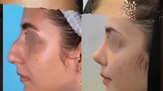 فرم بینی قبل از جراحی: استخوانی