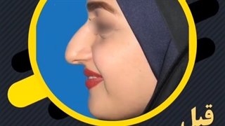 عمل بینی گوشتی با نتیجه نیمه فانتزی