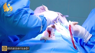 فیلم واقعی جراحی بینی گوشتی