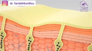 نحوه انجام کربوکسی تراپی