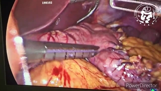 چه زمانی آبدومینوپلاستی کنیم؟ قبل یا بعد از اسلیو معده؟