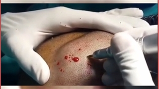 هزینه، معایب و مزایای کاشت مو به روش سوپرترکیبی