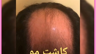 هزینه، معایب و مزایای کاشت مو به روش سوپرترکیبی
