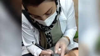 برداشتن خال با دستگاه RF Surgery