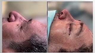 جراحی بینی ، لیفت پیشانی و عمل پلک پایین  | دکتر خوروش