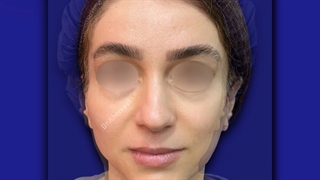 لیفت آندوسکوپی پیشانی و ابرو و تزریق چربی به صورت | دکتر خوروش کاشت ریش