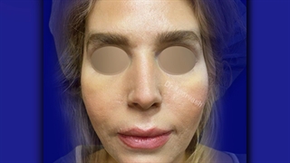 یک ماه بعد از پروتز چانه | دکتر خوروش