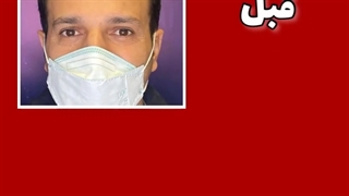 نتیجه بعد از کاشت مو (بدون عوارض کاشت مو)