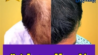 بدون عوارض کاشت مو 20 سال جوان تر شوید