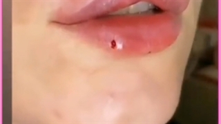 عوارض احتمالی تزریق ژل در نواحی مختلف صورت و بدن