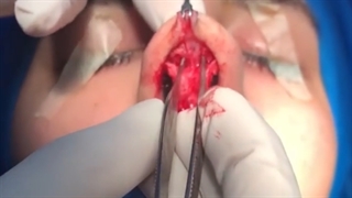 تخلیه فیلر قبل از جراحى بینى | دکتر شاهرخ خوش سیرت